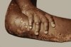 Spain issues nationwide alert over possible monkeypox outbreak