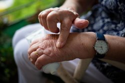 Arthritis could affect 1 billion people by 2050