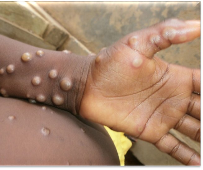 Monkeypox could be gone soon -- at least its name