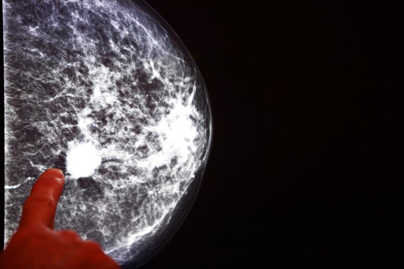 Some breast cancer patients could be spared chemotherapy's toxic side effects if a genetic test shows they are at low risk for recurrence, according to researchers at the University of California San Francisco. Photo by Tomas K/Shutterstock