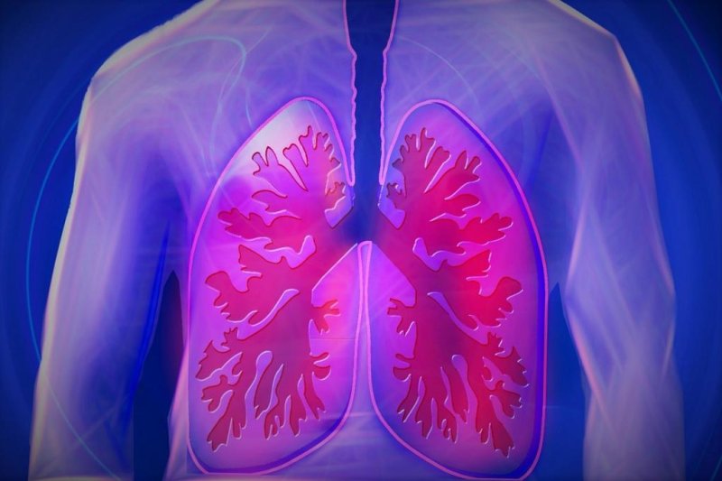 Scientists say a simple questionnaire can provide an early diagnosis for COPD. Photo by bykst/Pixabay