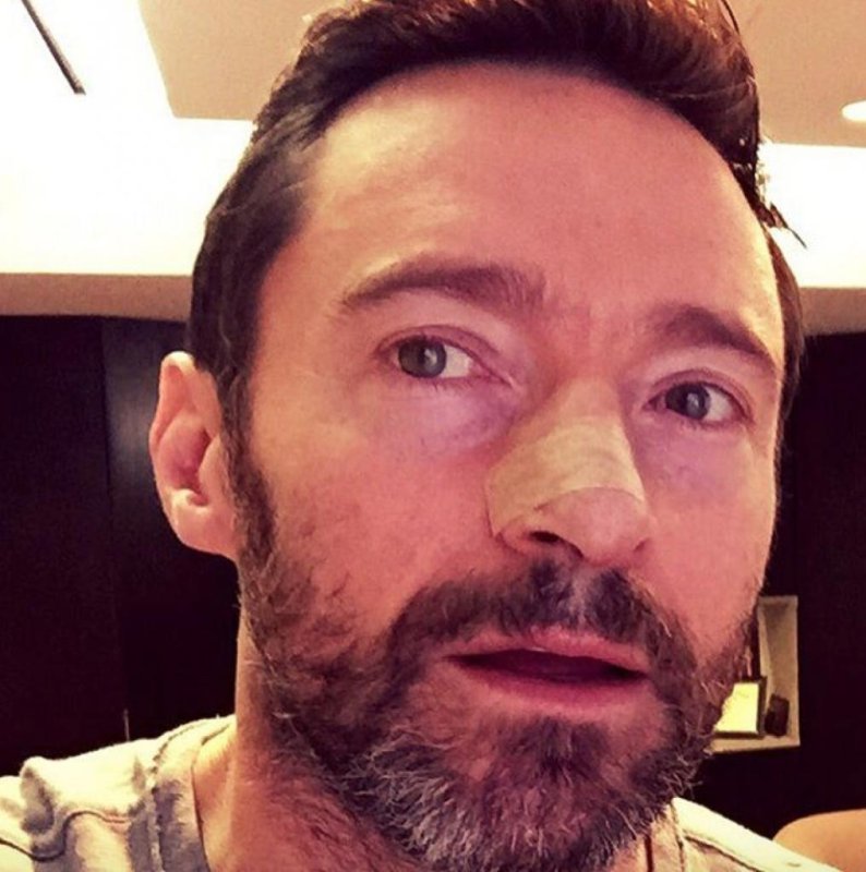 Actor Hugh Jackman shows off his latest bandage after the fourth skin cancer procedure on his nose. The actor has taken to social media multiple times to talk about his own battles with skin cancer to campaign for the use of sunscreen. Screen shot: Hugh Jackman/Instagram