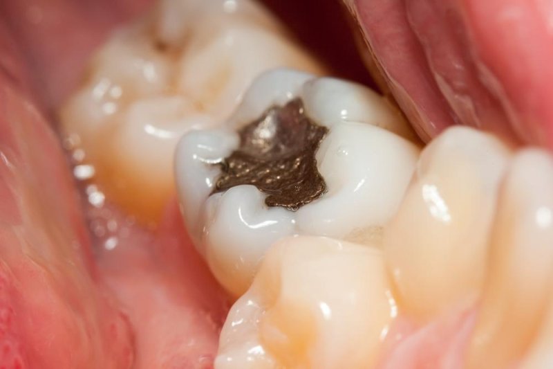 Too many dental fillings may increase mercury levels