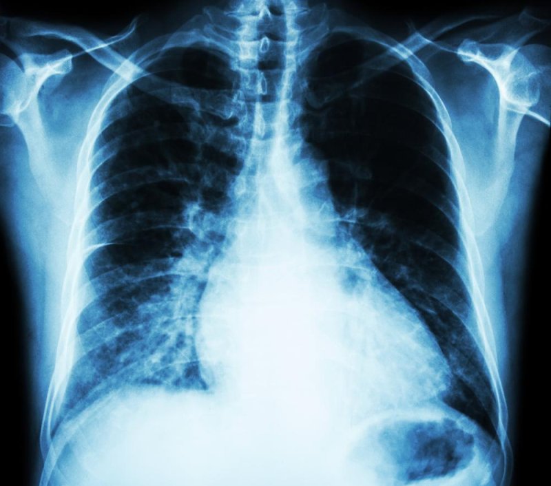 what causes fluid in the lungs