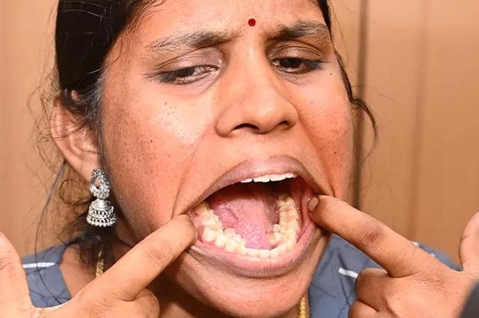 Kalpana Balan was awarded the Guinness World Records title for the most teeth in a person’s mouth (female). Photo courtesy of Guinness World Records