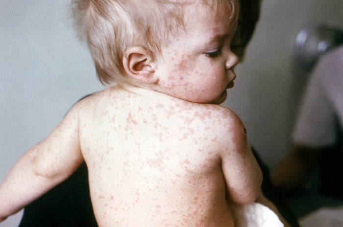 Berkeley student may have exposed many to measles