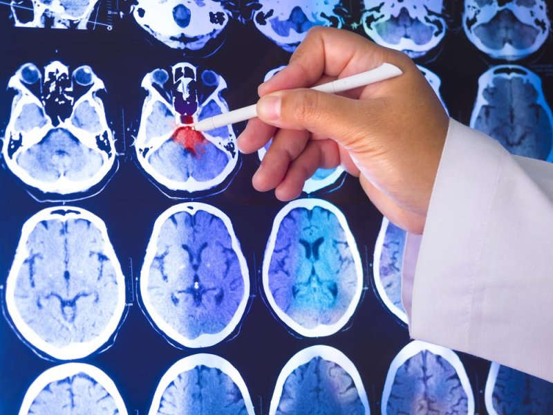 Research into brain diseases can be costly and includes many dead-ends, but seven companies are banding together on investment and research in an effort to bring the first new drugs for Parkinson's disease in more than a decade to the market, the organization Parkinson's UK announced. Photo by Mrs_ya/Shutterstock