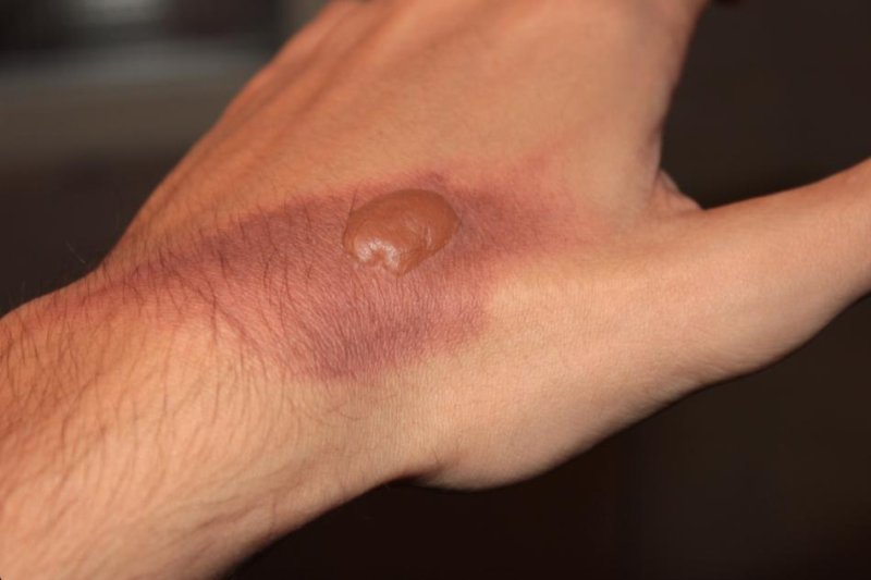 Researchers develop new method for healing burns