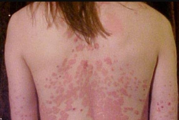 Compound treats psoriasis, may curb autoimmune diseases, researchers say