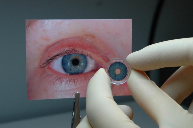 FDA approves first artificial iris for adults, children