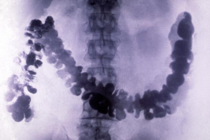 Starting colon, rectal cancer screening earlier reduces risk in women, study finds