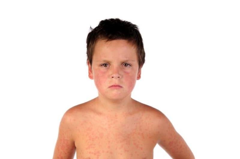 Measles virus attacks the cells that serve as the immune system's memory, wiping out established resistance to disease, a pair of new studies report. Photo courtesy of HealthDay News