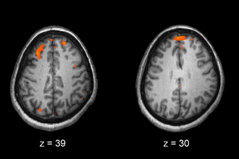 Scientists discover new genetic roots of schizophrenia