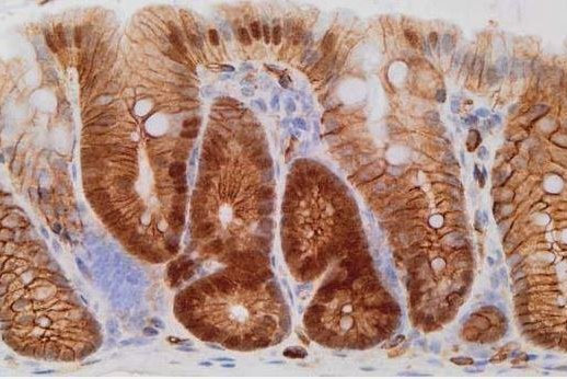 Antifungal drug eliminates dormant bowel cancer cells in mice