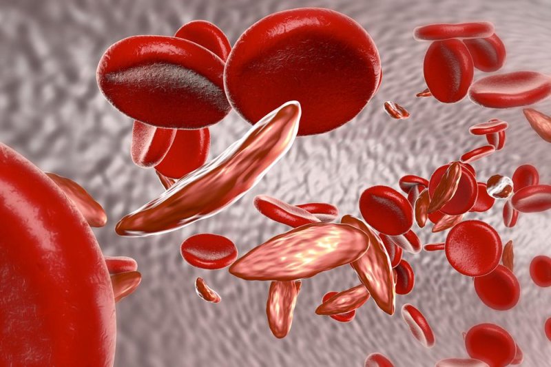 Opioids not ideal for sickle cell patients' pain management, study says