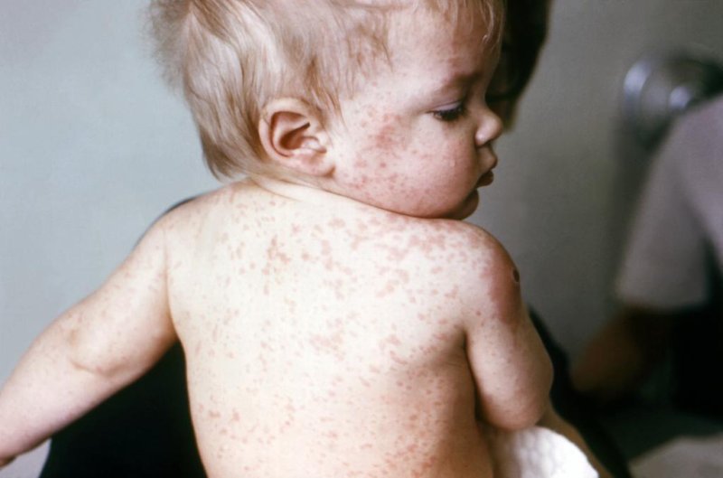 A child with the measles. (CDC)