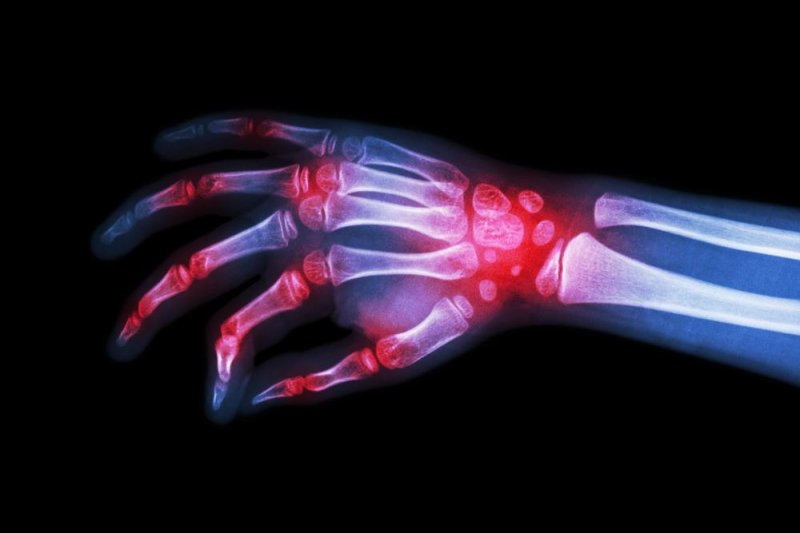 Rheumatoid arthritis is an autoimmune disease characterized by the immune system attacks a patient's joints. Stimulating the vagus nerve appears to lessen symptoms, including inflammation that drives the disease. Photo by Puwadol Jaturawutthichai/Shutterstock