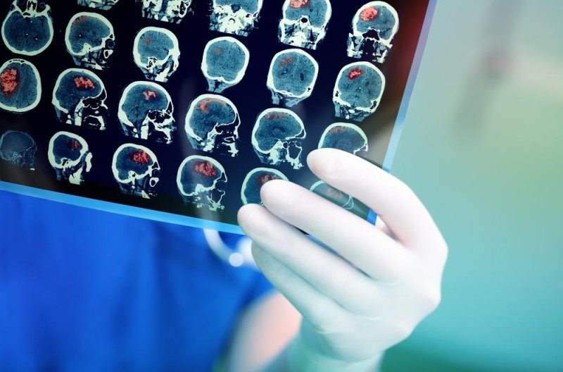 It can be difficult to distinguish between recurrent brain cancer and dead cells caused by radiation therapy, but researchers found a computer program was nearly twice as accurate as doctors at diagnosis. Photo by sfam_photo/Shutterstock