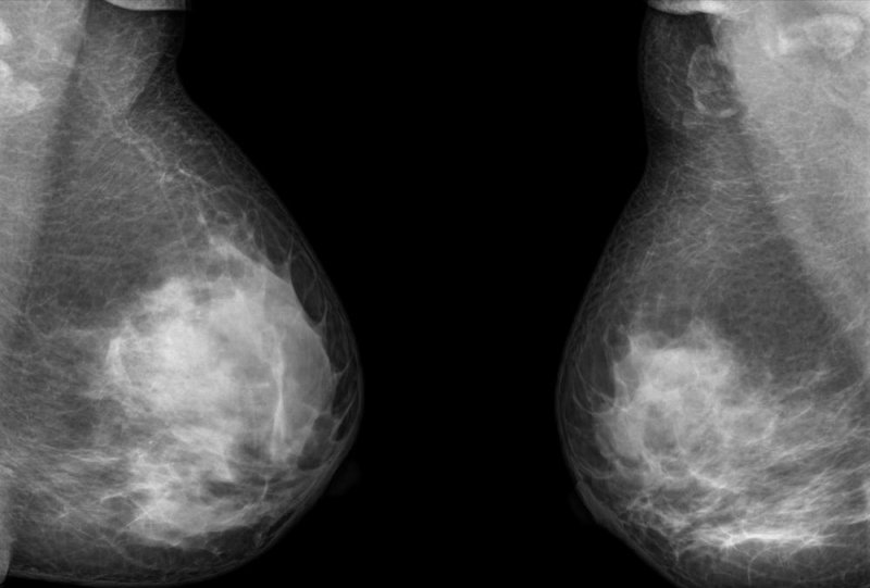 Drug instigates strong immune response in certain breast cancers