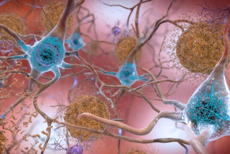 Beta-amyloid plaques and tau in the brain are two hallmarks of Alzheimer's disease, a topic spurring much research and some questions about scientific integrity. Photo courtesy of National Institute on Aging/NIH