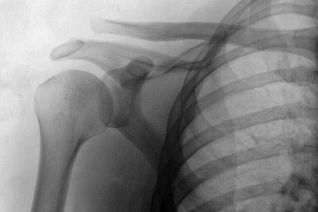 Dislocation of the AC joint is often fixed by surgical placement of a plate and screws, however patients who wore a sling and had rehabilitation instead recovered from their injury faster. Photo by Jay F. Cox/Wikimedia Commons