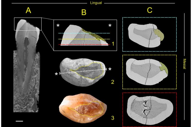 World's oldest dental fillings found in Italy