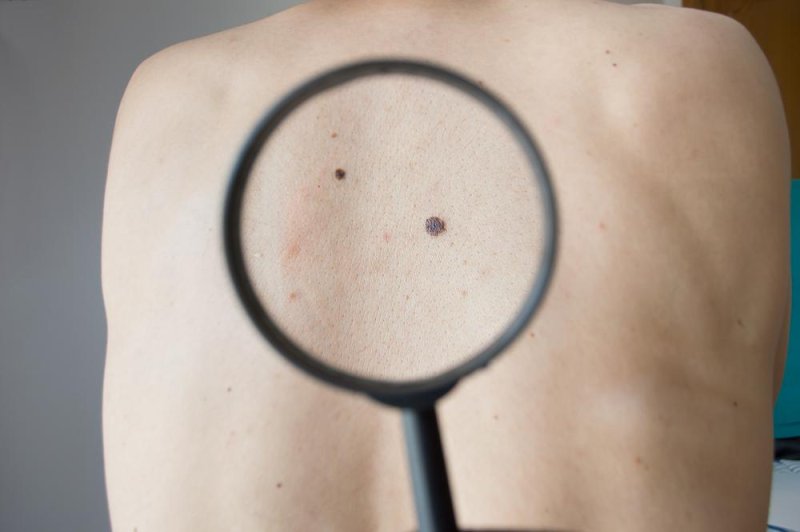 The two-drug combination was shown to be so effective at shrinking melanoma tumors the FDA granted it "priority" status to speed its approval for use with patients. Photo by cunaplus/Shutterstock