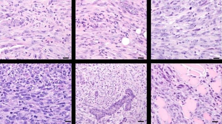 Mammary tumors caused by deleting CCN6 look like metaplastic carcinoma.Researchers at the University of Michigan have developed a new mouse model to identify key genetic driver in rare type of breast cancer. Photo courtesy University of Michigan Health System