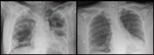 A 67-year-old woman infected by the novel coronavirus suffered from pneumonia (L). She recovered after being treated with blood plasma from COVID-19 survivors (R). Image courtesy of Severance Hospital