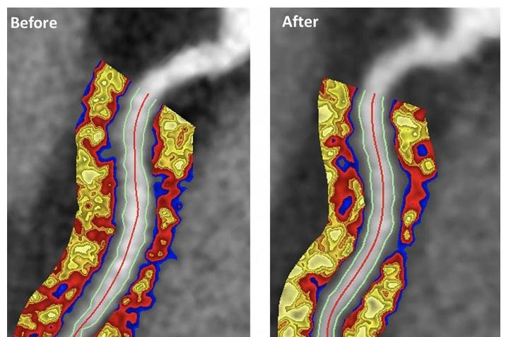 The researchers made the discovery using a novel imaging biomarker, the perivascular fat attenuation index. It detected coronary artery inflammation which decreases fat tissue known as perivascular fat around the arteries.Image by&nbsp;NHLBI.