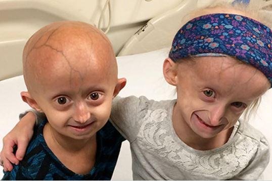 Children with Hutchinson-Gilford Progeria Syndrom have an average life expectancy of around 15 years as they develop aging symptoms. Photo courtesy of <a class="tpstyle" href="https://www.progeriaresearch.org/meet-the-kids/">Progeria Research Foundation</a>