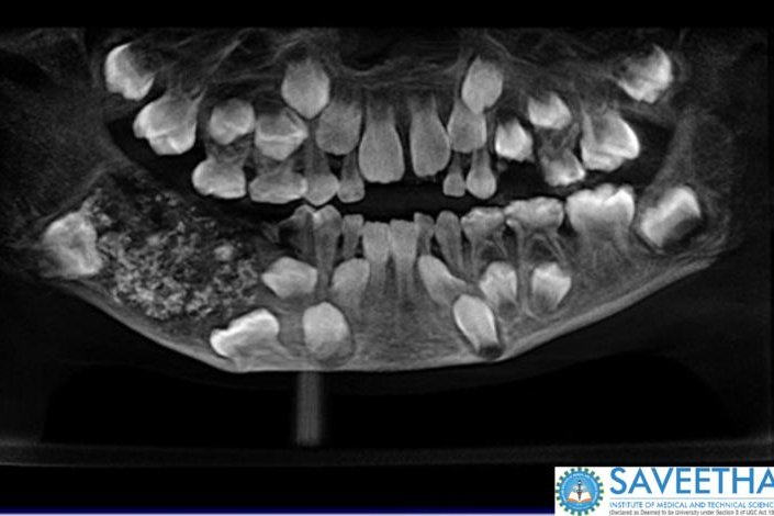 Dentists at a hospital in India removed more than 500 teeth from the mouth of a 7-year-old boy who had suffered a swollen jaw for years. Photo courtesy of Saveetha Dental College and Hospital