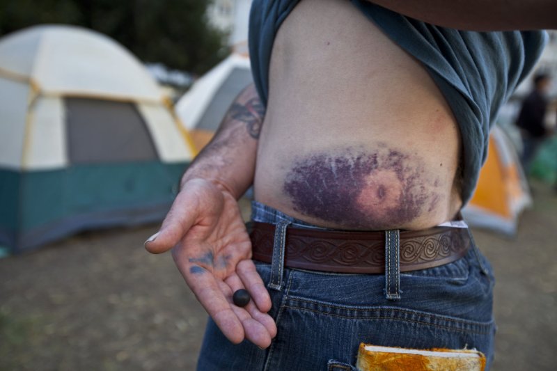 Occupy Oakland protester Shamus Collins shows off the rubber bullet and the bruise it produced after being shot by police as he went to the aid of injured Iraqi war veteran Scott Olsen in Oakland, Calif., Oct. 215, 2011. UPI/Terry Schmitt