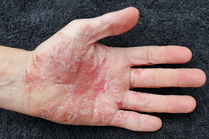 Psoriasis is a chronic skin condition that affects more than 8 million Americans, according to the National Psoriasis Foundation. File Photo by Psoriasis-Netz/<a href="https://creativecommons.org/licenses/by/2.0/legalcode">Flickr</a>
