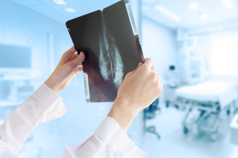 The American Cancer Society currently advises that women aged 40 to 44 consider the "option" of annual mammography, while women aged 45 to 54 should get the yearly screen. File Photo by uschenkova/Shutterstock