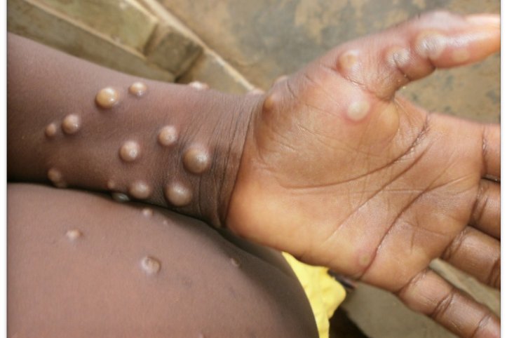 The World Health Organization has decided to rename monkeypox, the virus that is causing global suffering. Image courtesy of WHO