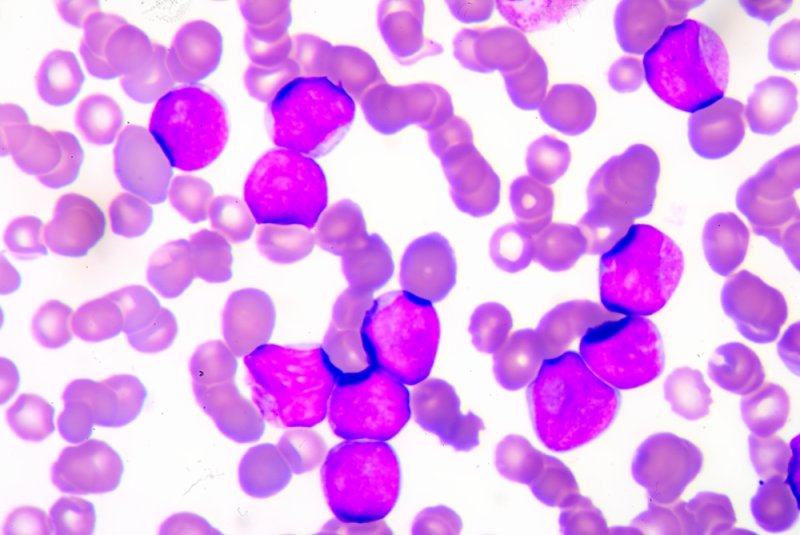 Drug offers hope for acute myeloid leukemia treatment in older adults
