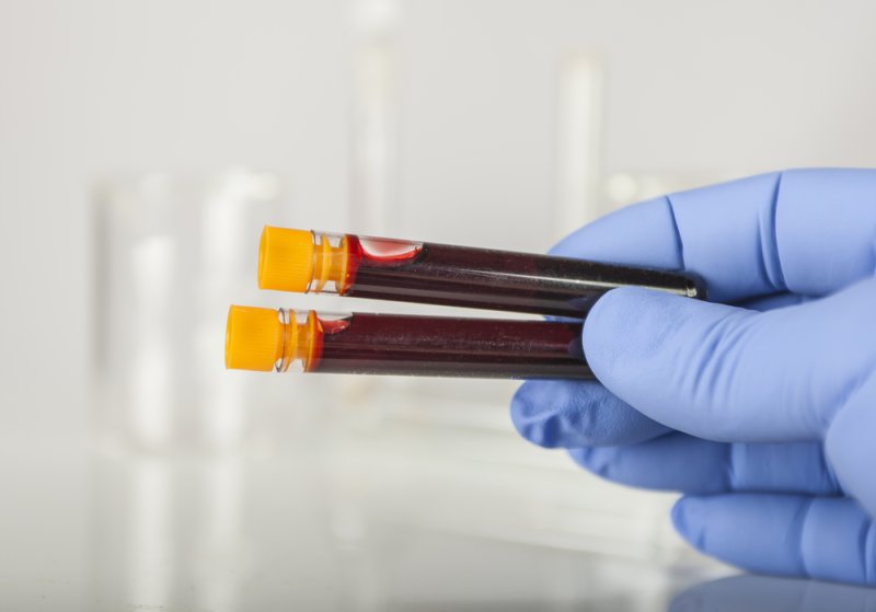 Because many serious ailments have similar indicators as common viral infections, scientists say blood tests can be used to trim down hospital visits. Photo by Steve Collender/Shutterstock