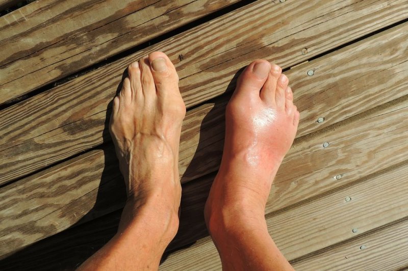 Study shows gout medication is safe for patients with kidney disease