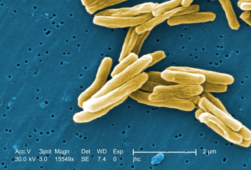 Researchers have determined a way to differentiate the active form of the TB bacteria from its latent form in a diagnostic blood test able to be performed in both urban and rural areas around the world. Image courtesy the U.S. Centers for Disease Control and Prevention