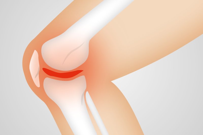 Researchers find potential treatment for knee, spine osteoarthritis