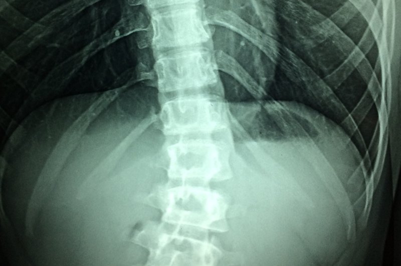 Researchers believe an existing drug could help treat spinal cord injuries. Photo by Taokinesis/<a href="https://pixabay.com/en/x-rays-hospital-disability-doctor-1715903/">Pixabay</a>