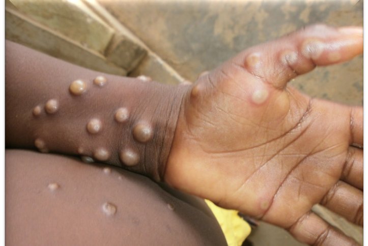 Health officials examine effectiveness of antiviral drugs for treating monkeypox