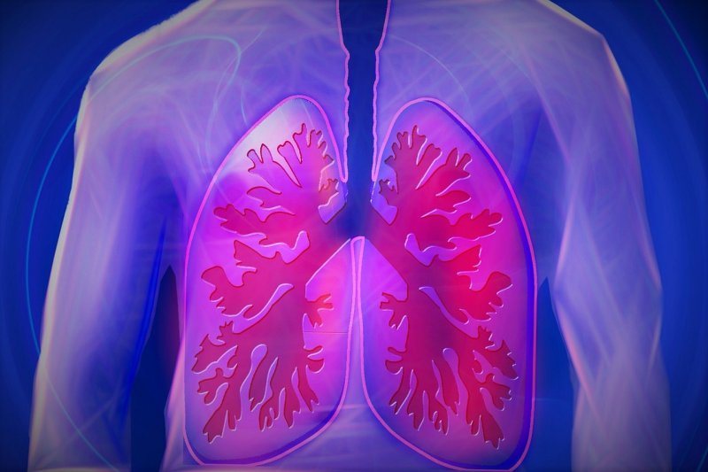 A recent study of lung cancer patients found that 88% of those on Tagrisso were still alive five years after their initial surgery for their lung cancer, compared to 78% of those on placebo. Photo by kalhh/Pixabay