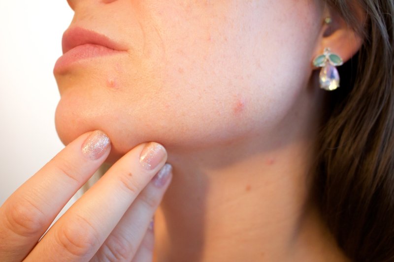 Squeezing pimples could make acne worse