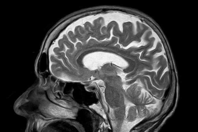 Older adults with history of head injuries show decreased brain function