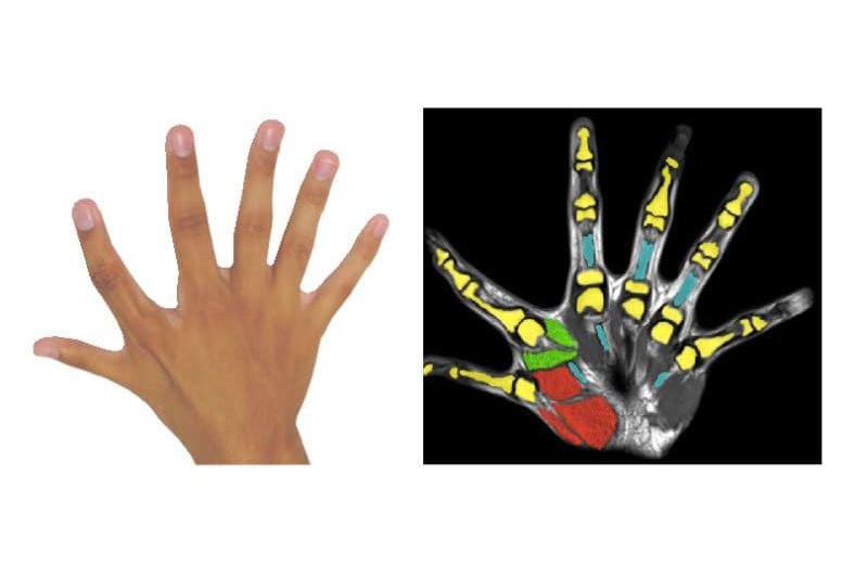 Having an extra finger can enable people to&nbsp;execute movements with a single hand that would otherwise require two. Photo courtesy of HealthDay News